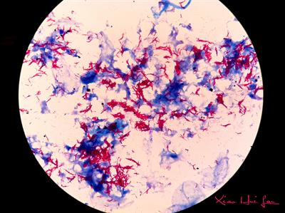 Positive acid fast smear: Ziehl-Neelsen stain of Mycobacterium tuberculosis complex