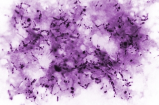A photomicrograph revealing numerous, Gram-positive, rod-shaped, Mycobacterium tuberculosis bacilli.